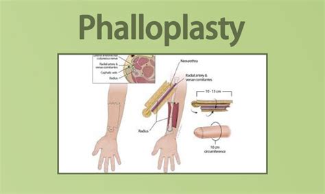 faloplastia|Phalloplasty: Surgery and After Care